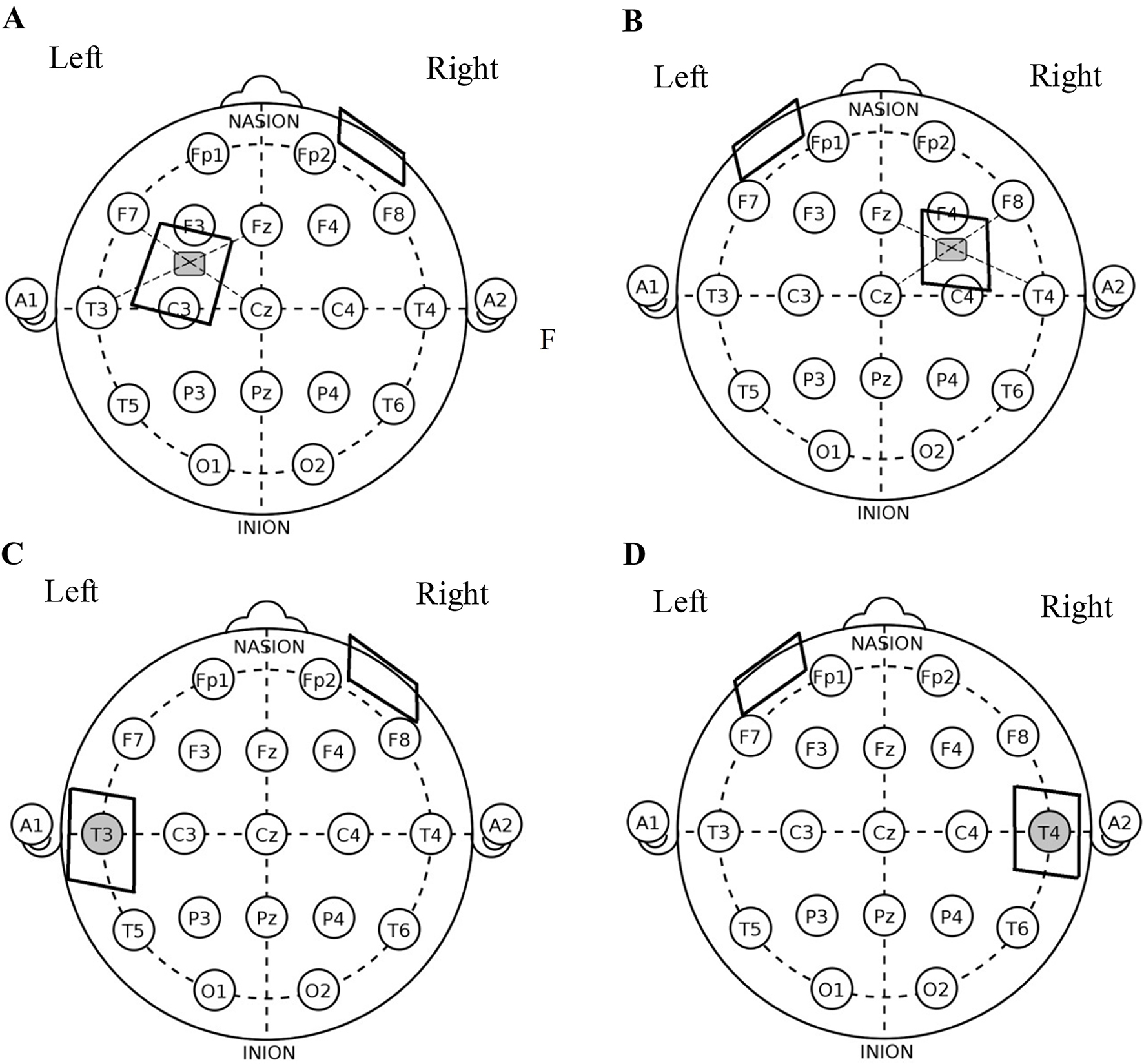 Comparison Of The Effect Of Four Transcranial Direct Current Stimulation Configurations On Picture Naming Improvement In Non Fluent Aphasia A Randomized Clinical Trial Comparison Of The Effect Of Four Transcranial Direct Current Stimulation Configurations On Picture Naming Improvement In Non Fluent Aphasia A Randomized Clinical Trial