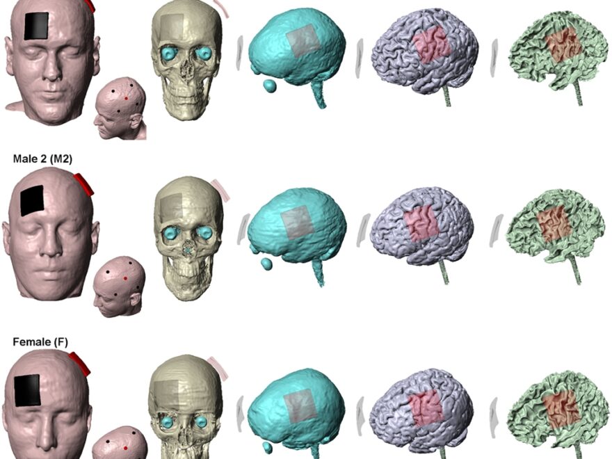 Frontiers Inter Individual Variation During Transcranial Direct Current Stimulation And Normalization Of Dose Using MRI Derived Computational Models